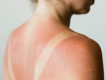 Sonnenbrand behandeln: Pflegende After-Sun-Lotionen oder Cremes mit Aloe vera wirken lindernd. Sonnenbrand behandeln: Pflegende After-Sun-Lotionen oder Cremes mit Aloe vera wirken lindernd.